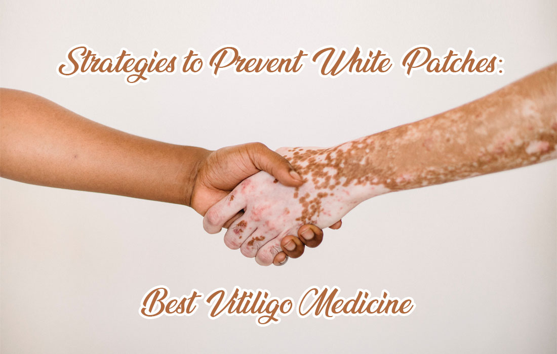Strategies to Prevent White Patches: Best Vitiligo Medicine
