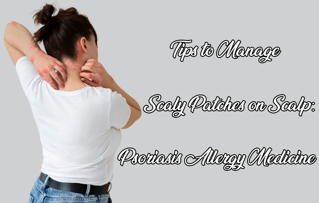 Tips to Manage Scaly Patches on Scalp: Psoriasis Allergy Medicine